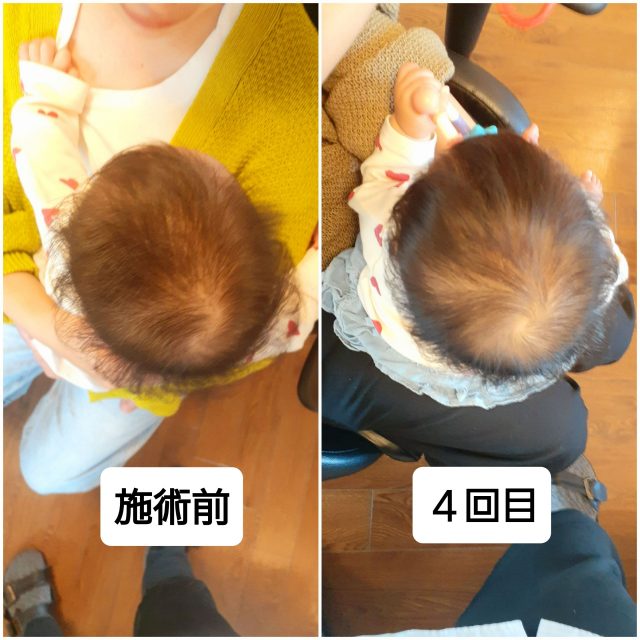【赤ちゃん整体】赤ちゃんの斜頭・絶壁・頭の形にお悩みのママさんへ