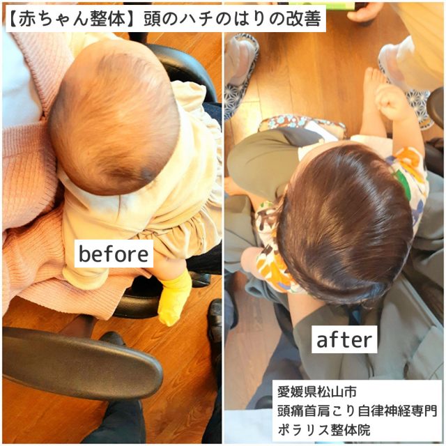 【赤ちゃん整体】赤ちゃんの頭の形/斜頭/絶壁にお悩みのママさんへ