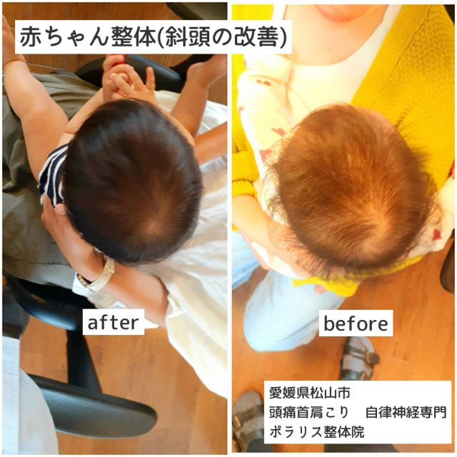 赤ちゃん整体/お子様の頭の歪みにお悩みのママさんへ